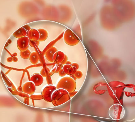 【全自动白带分析仪】厂家山东国康提醒阴道炎反反复复的4个误区