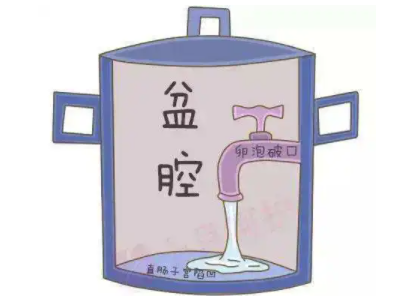 盆腔积液是怎么回事？白带分析仪厂家提醒早了解早预防