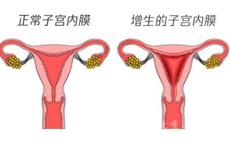 白带常规检测仪厂家解读子宫内膜增生是什么原因引起的