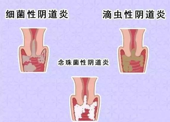 全自动阴道分泌物检测仪厂家提醒您还在拖延吗，还在等阴道炎自愈吗？